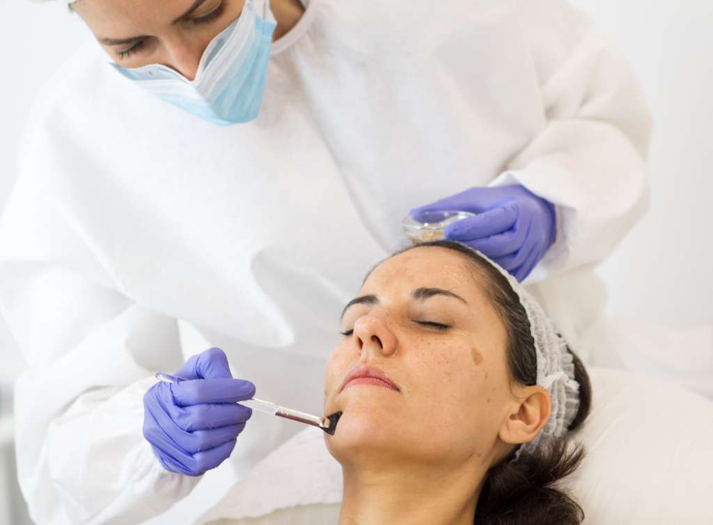 Peeling químico para 